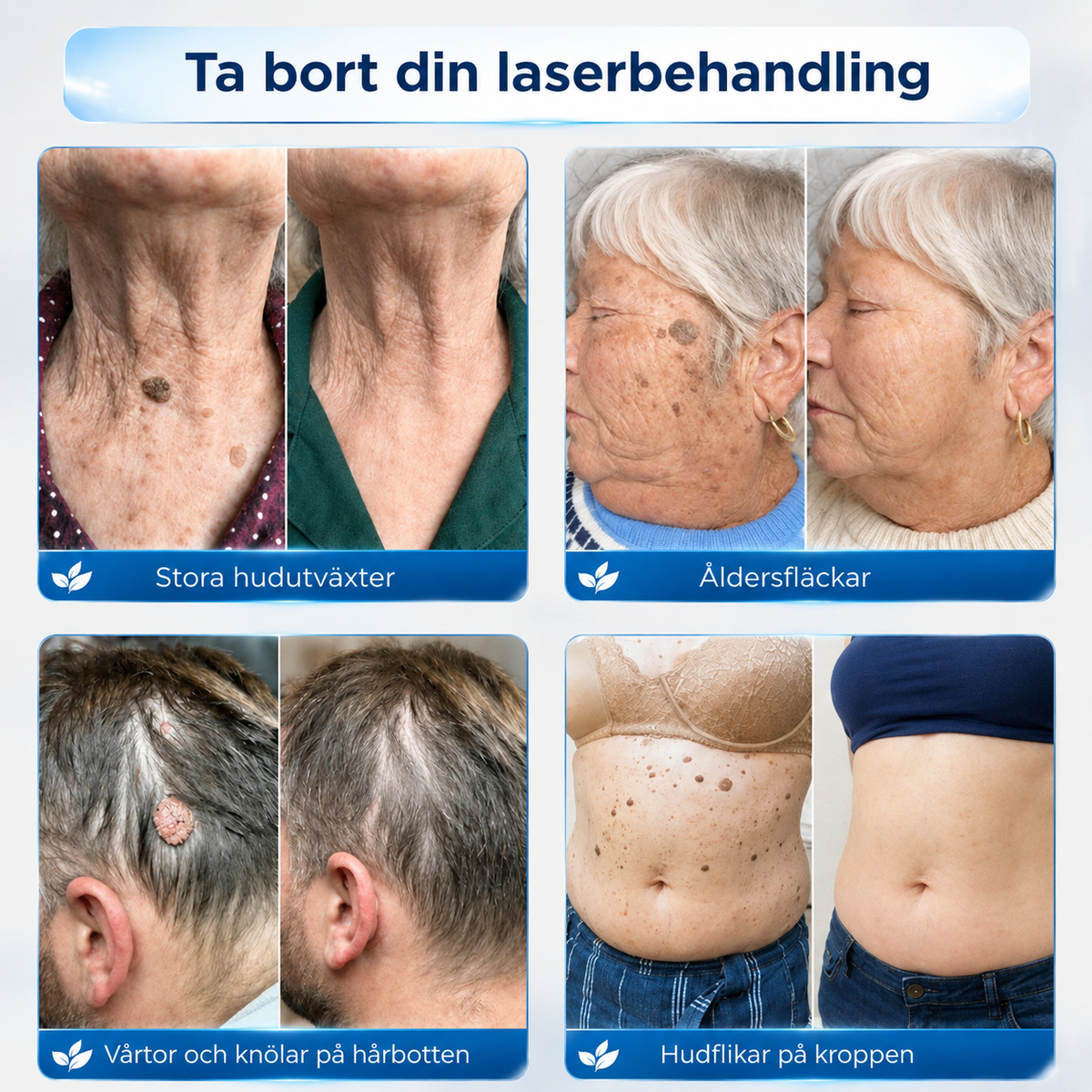 HudRen™ | Roll-on för hudflikar och vårtor